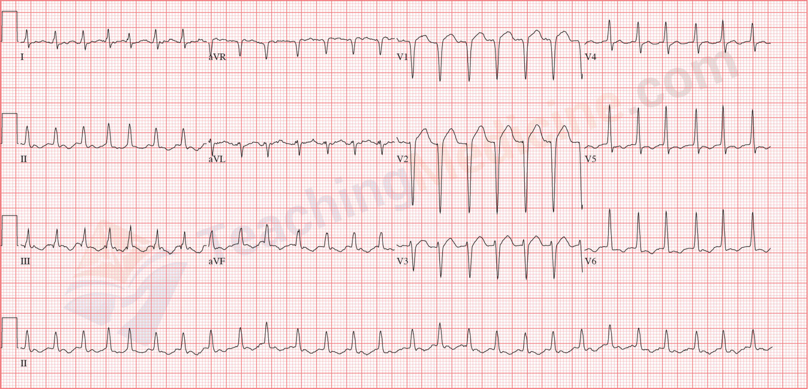 The QRS is wide in this example of atrial fibrillation